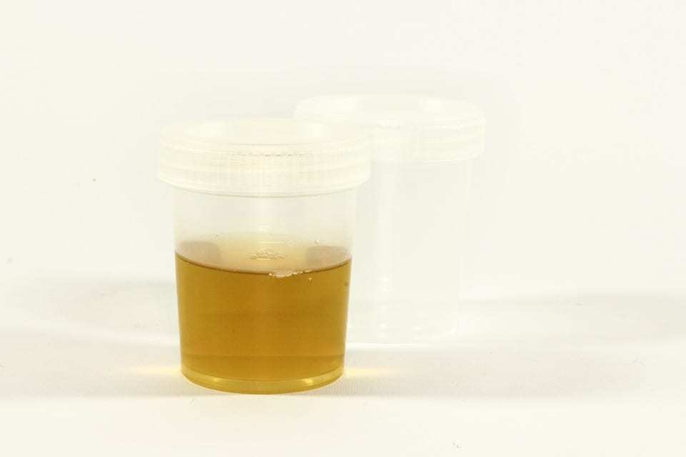 does b12 injection change urine color Bright yellow urine: Colors, changes, and causes What Color is Vitamin B12