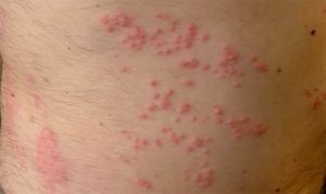 Sea Lice Make It To Jersey Shore Waters - Jersey Shore Online